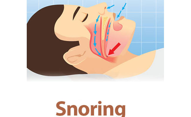 Snoring Complications: Symptoms, Causes And Treatment