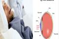 Sleep apnea patients at glaucoma risk - Sakshi Post
