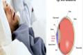 Sleep apnea patients at glaucoma risk Sleep apnea patients at glaucoma risk - Sakshi Post