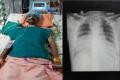 The 45-year-old man has two beating hearts - Sakshi Post