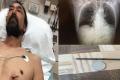 Doug Bergeson and the nail he shot himself with Doug Bergeson and the nail he shot himself with - Sakshi Post