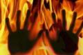 An 18-year-old girl, who was allegedly thrashed by her jilted lover and his father and then set ablaze in Isarwal village, on Saturday. - Sakshi Post