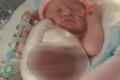Ava-Rose Nightingale suffered from gastroschisis - Sakshi Post