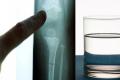 High levels of fluoride can weaken bones, leading to skeletal fluorosis - Sakshi Post