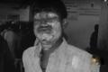 Victim Aizaz with burn injuries all over his face - Sakshi Post