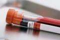 Blood test would help early detection of cancers affecting the ovary, liver - Sakshi Post