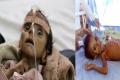 Malnutrition Kills 85K Yemeni Kids - Sakshi Post