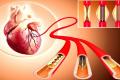 Now, Poor Patients Can Get Angioplasty At This Hospital - Sakshi Post