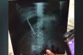 Doctors At Hyderabad’s NIMS Leave Forceps In Patient’s Abdomen - Sakshi Post