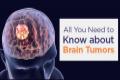 Brain Tumor: Causes, Symptoms & Treatment Options - Sakshi Post