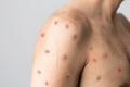 Kerala: First Suspected Case Of Monkeypox Reported  - Sakshi Post