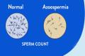  Know More About Azoospermia - Sakshi Post