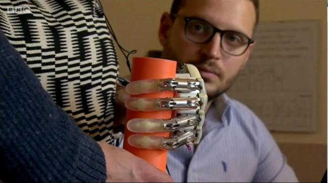 The bionic hand is the first with a sense of touch portable enough to be worn outside a laboratory. - Sakshi Post