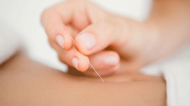 Acupuncture -- a traditional Chinese medicine in which thin needles are inserted into the body -- has become a widely used treatment prior to and during IVF - Sakshi Post