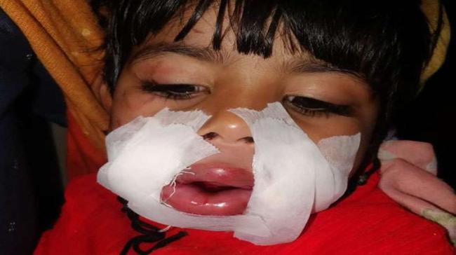 Injured 3 year old - Sakshi Post