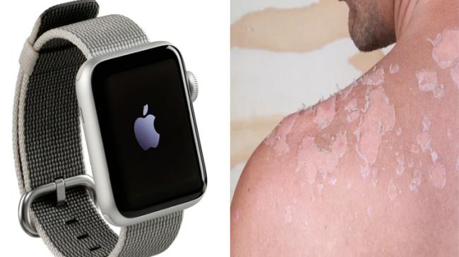 Can Apple Watch Prevent Skin Cancer? - Sakshi Post