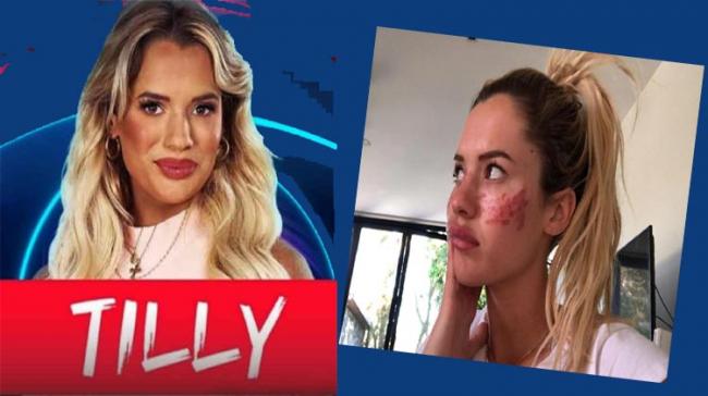 Big Brother star Tilly Whitfield face damaged after TikTok beauty hack goes wrong - Sakshi Post