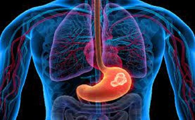 early diagnosis of cancer - Sakshi Post