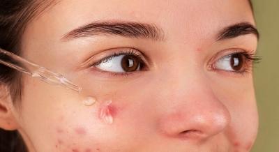 What causes warts and how to get rid of them? - Sakshi Post